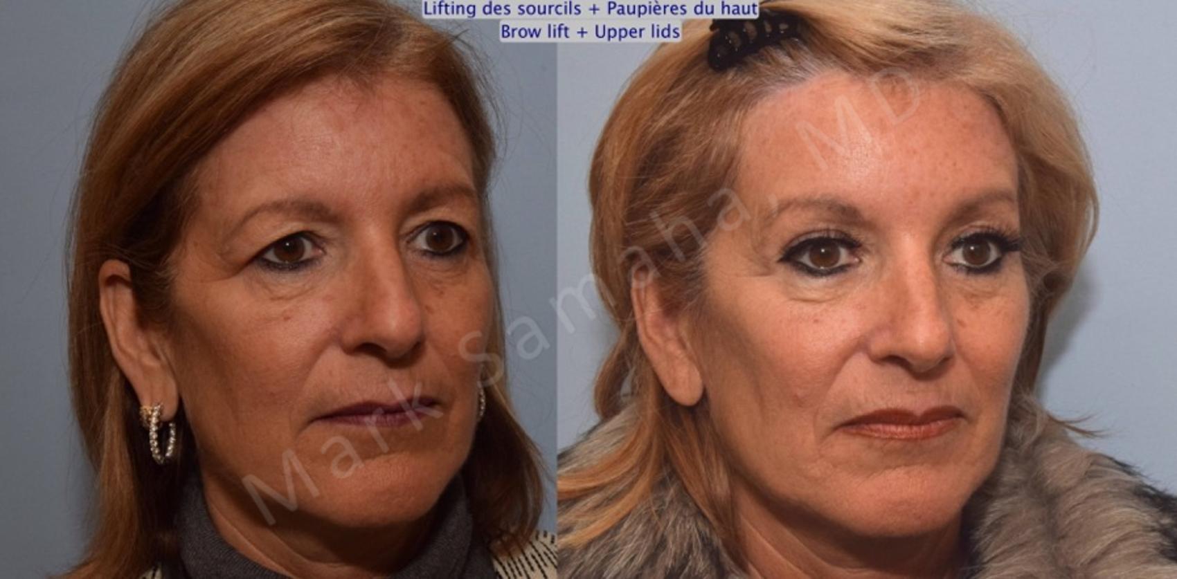 Before & After Lifting du Sourcil / Brow lift Case 90 View #4 Detail View in Montreal, QC