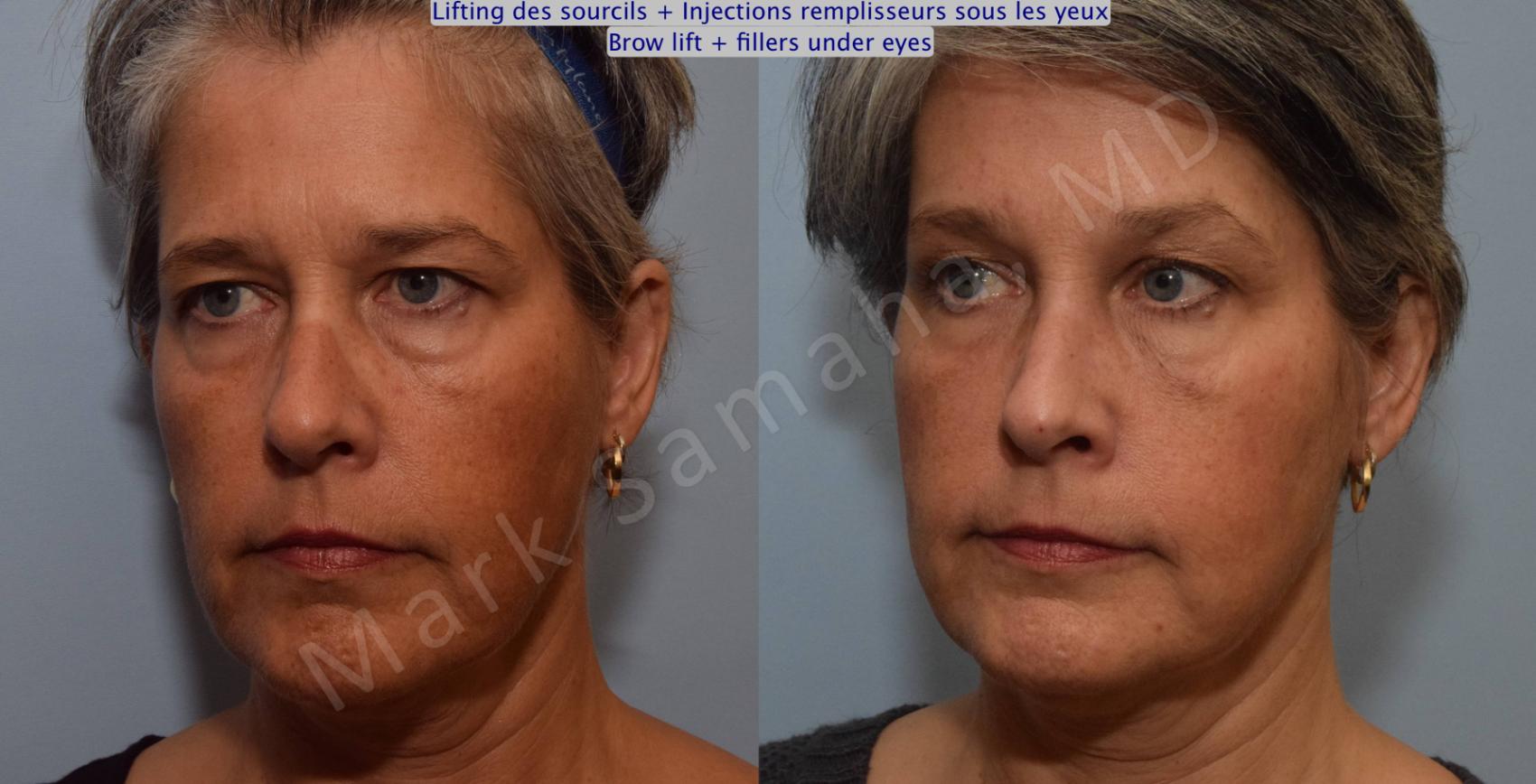 Before & After Lifting du Sourcil / Brow lift Case 97 View #2 View in Montreal, QC