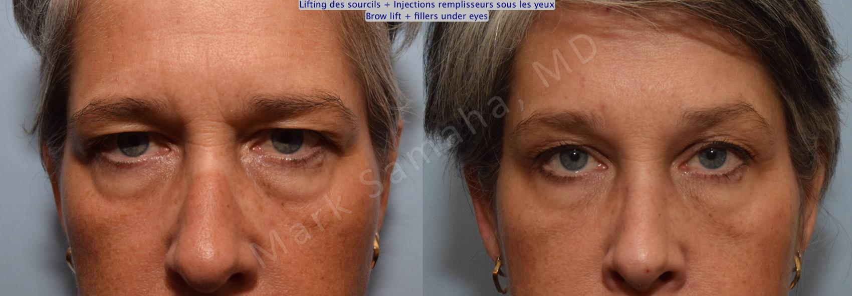 Before & After Lifting du Sourcil / Brow lift Case 97 View #4 View in Montreal, QC