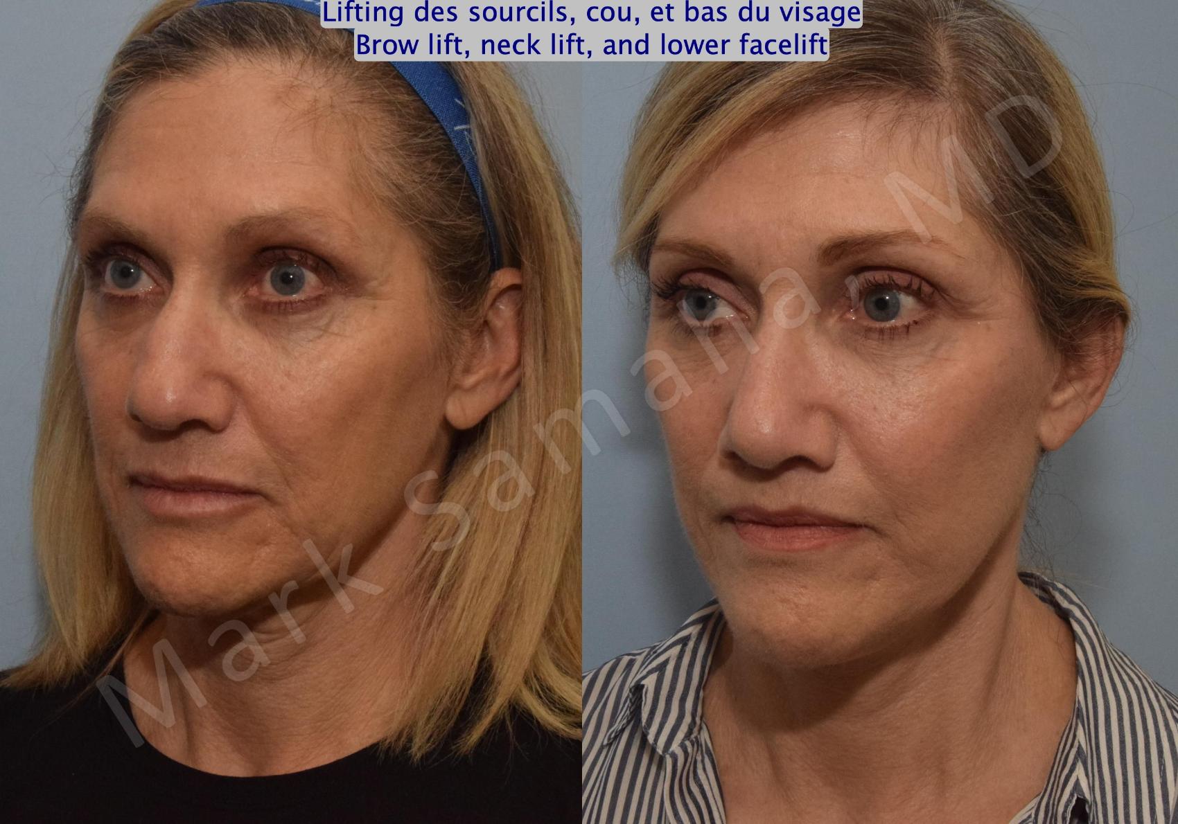 Before & After Lifting du Sourcil / Brow lift Case 145 Left Oblique View in Montreal, QC