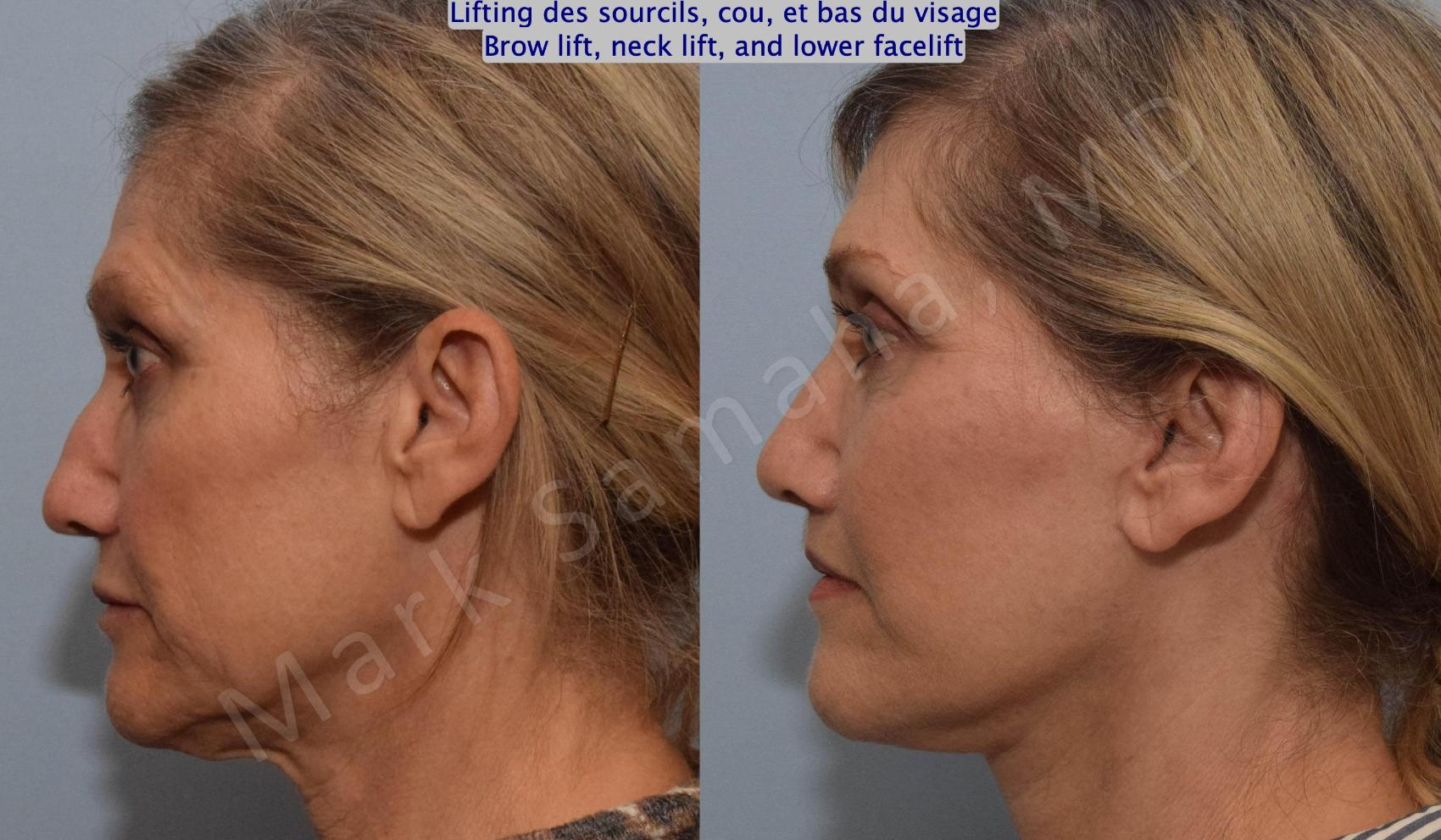 Before & After Lifting du Sourcil / Brow lift Case 145 Left Side View in Montreal, QC