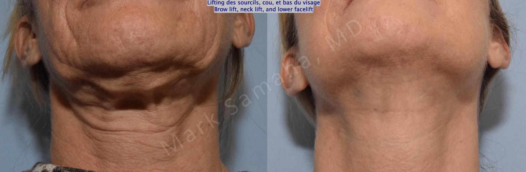 Before & After Lifting du Sourcil / Brow lift Case 145 Neckcou View in Montreal, QC