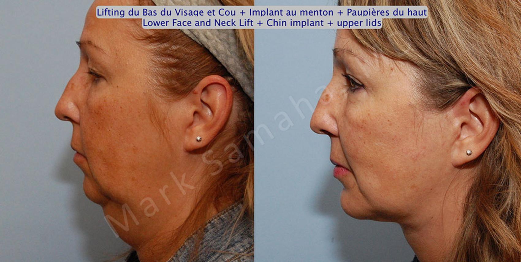Before & After Augmentation du menton / Chin Augmentation Case 17 View #1 View in Montreal, QC
