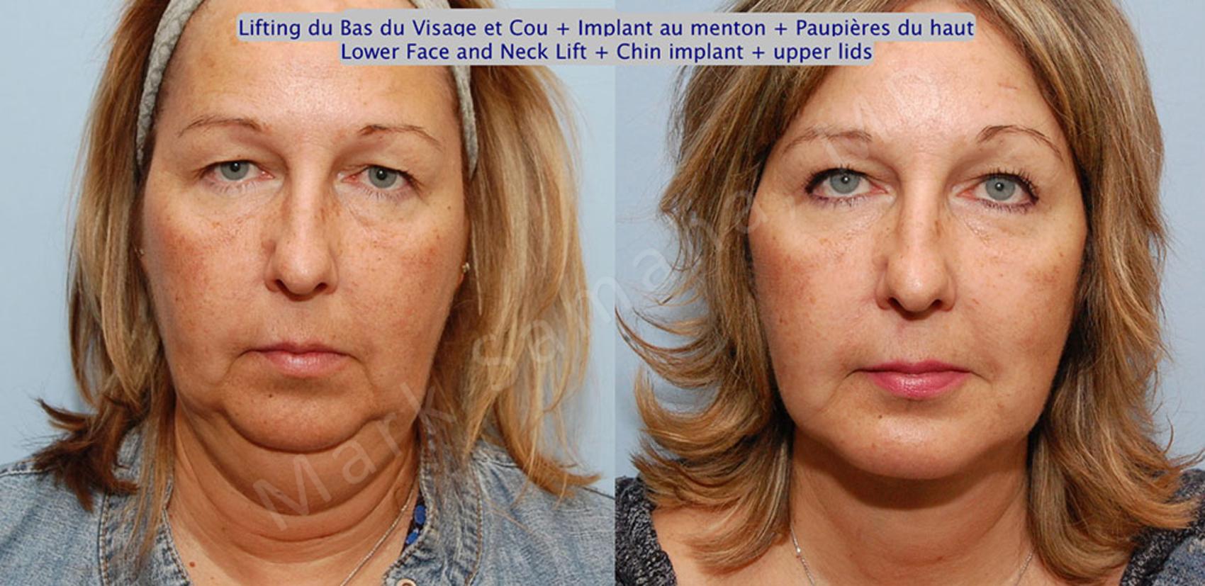 Before & After Augmentation du menton / Chin Augmentation Case 17 View #2 View in Montreal, QC