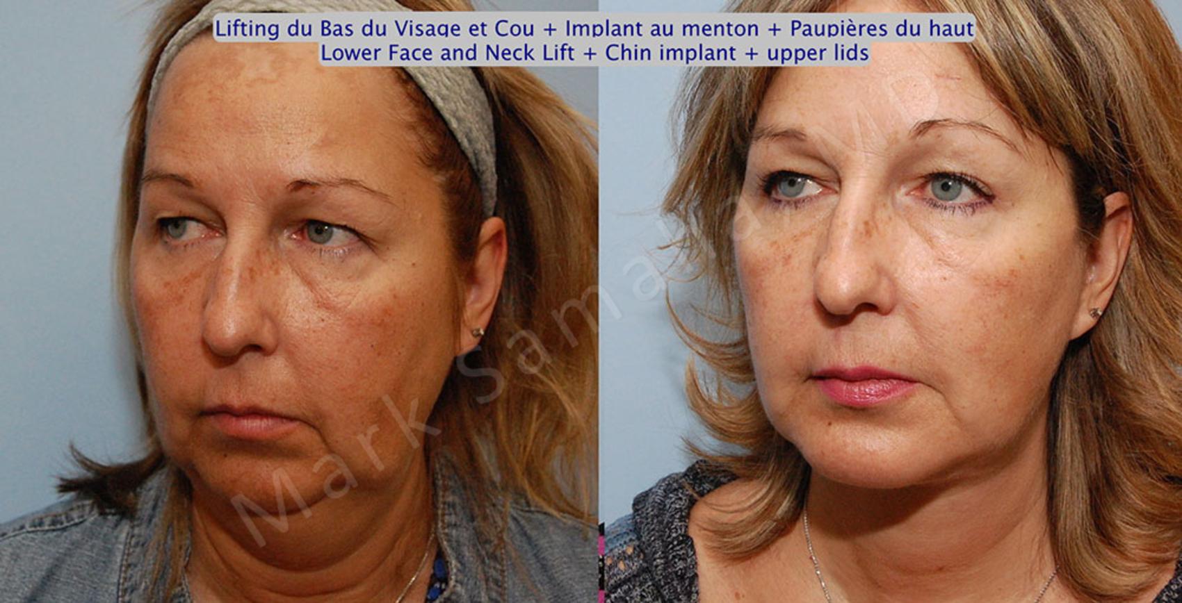 Before & After Augmentation du menton / Chin Augmentation Case 17 View #3 View in Montreal, QC