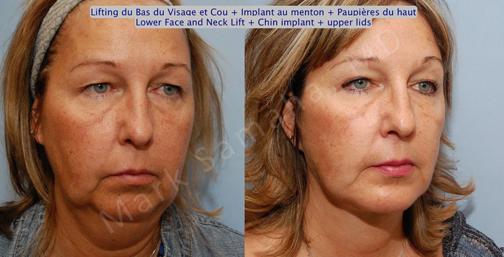 Before & After Augmentation du menton / Chin Augmentation Case 17 View #4 View in Montreal, QC