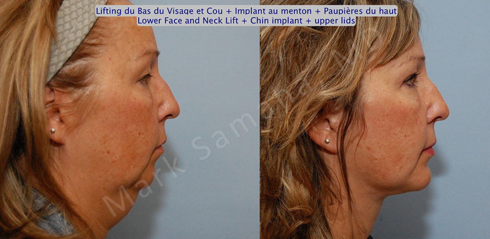 Before & After Augmentation du menton / Chin Augmentation Case 17 View #5 View in Montreal, QC