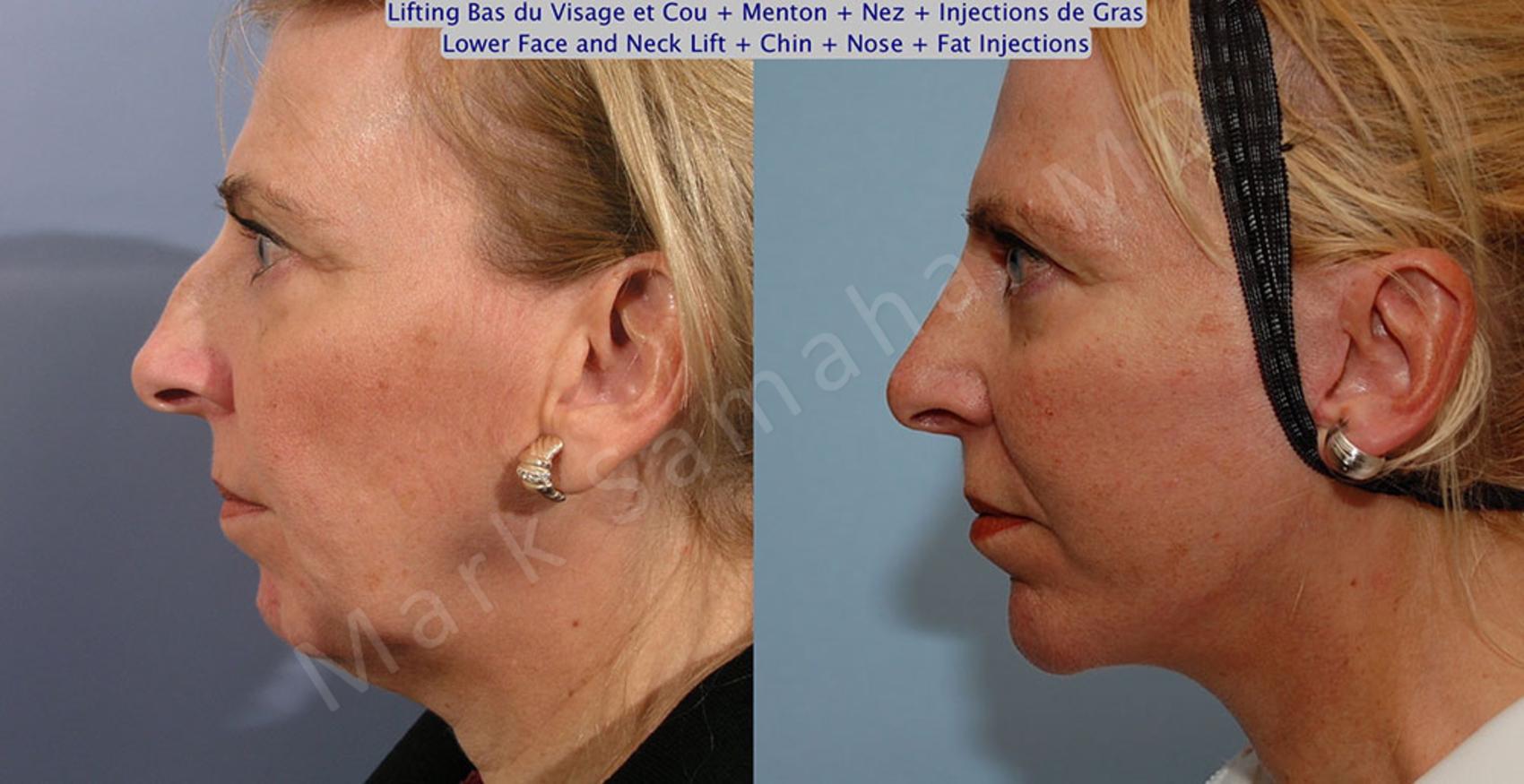 Before & After Augmentation du menton / Chin Augmentation Case 19 View #1 #Detail2 View in Montreal, QC