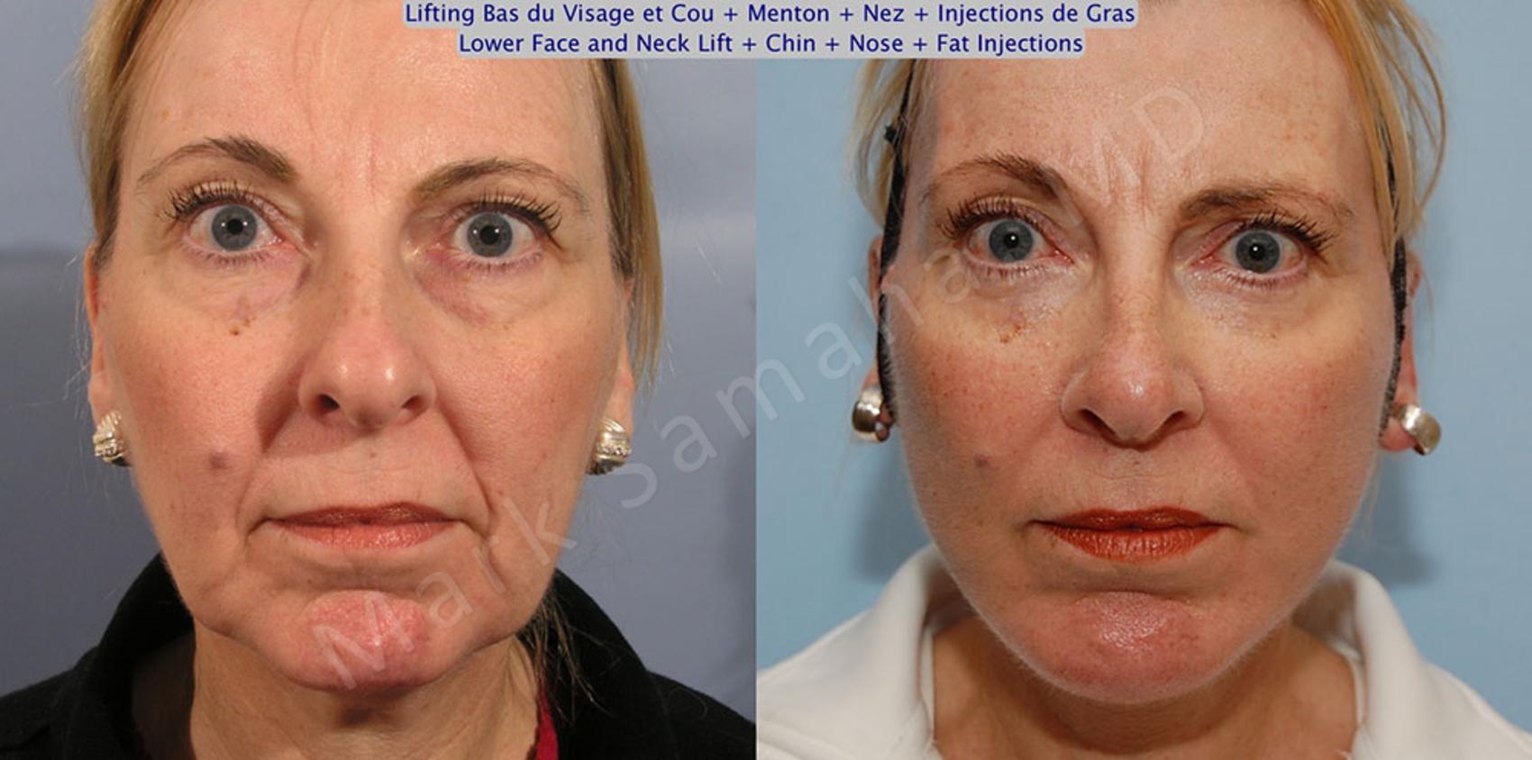 Before & After Augmentation du menton / Chin Augmentation Case 19 View #2 #Detail2 View in Montreal, QC