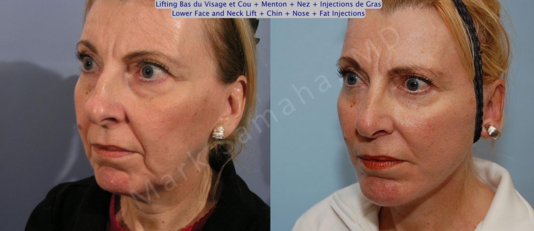 Before & After Augmentation du menton / Chin Augmentation Case 19 View #3 #Detail2 View in Montreal, QC