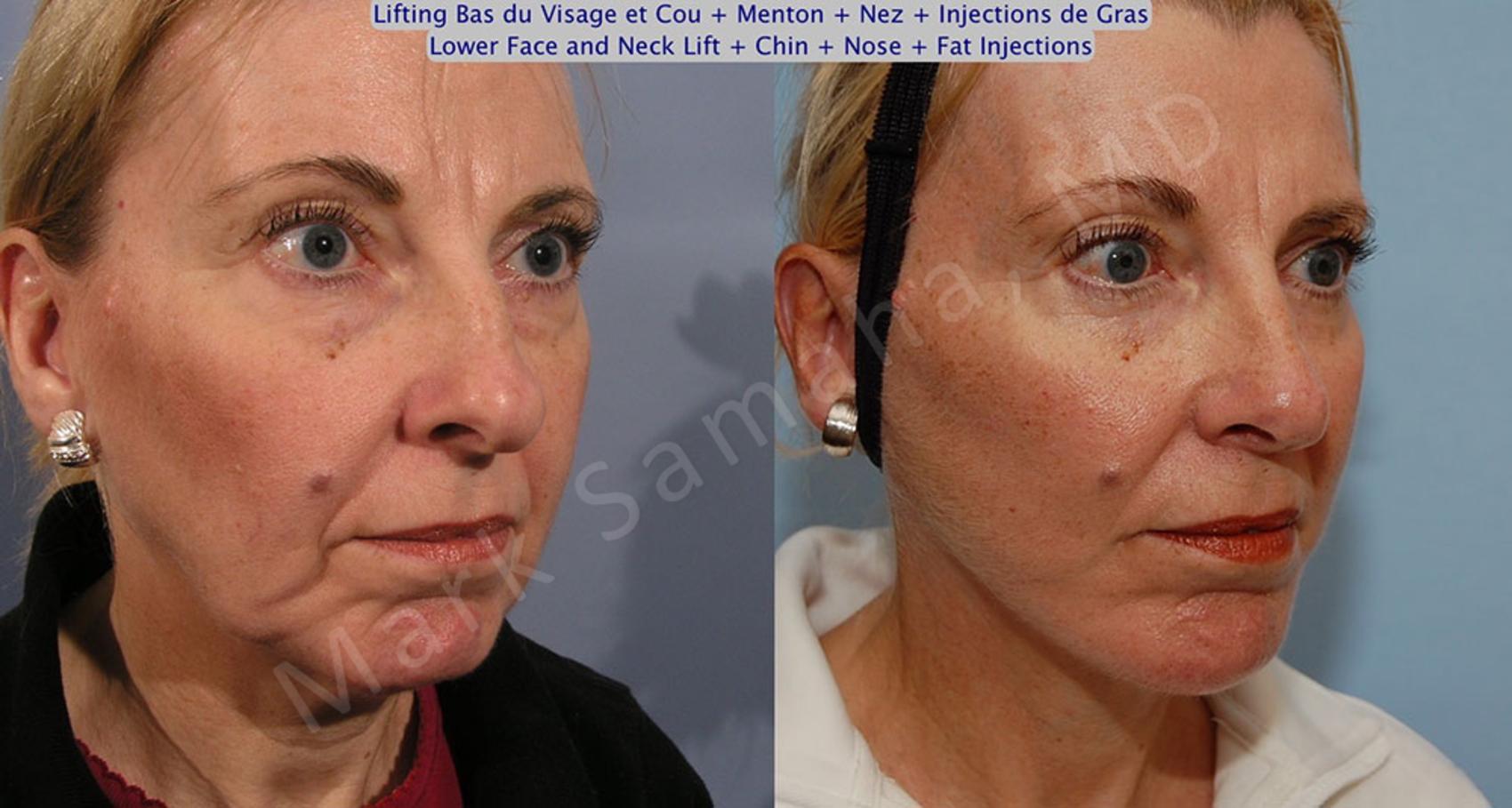 Before & After Augmentation du menton / Chin Augmentation Case 19 View #4 #Detail2 View in Montreal, QC