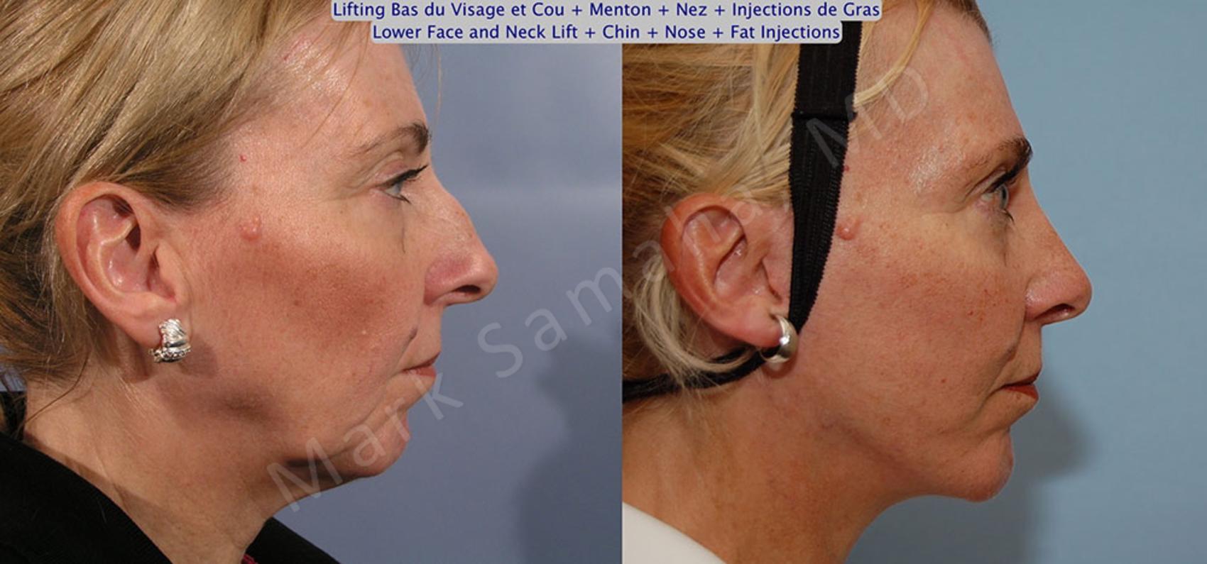 Before & After Augmentation du menton / Chin Augmentation Case 19 View #5 #Detail2 View in Montreal, QC