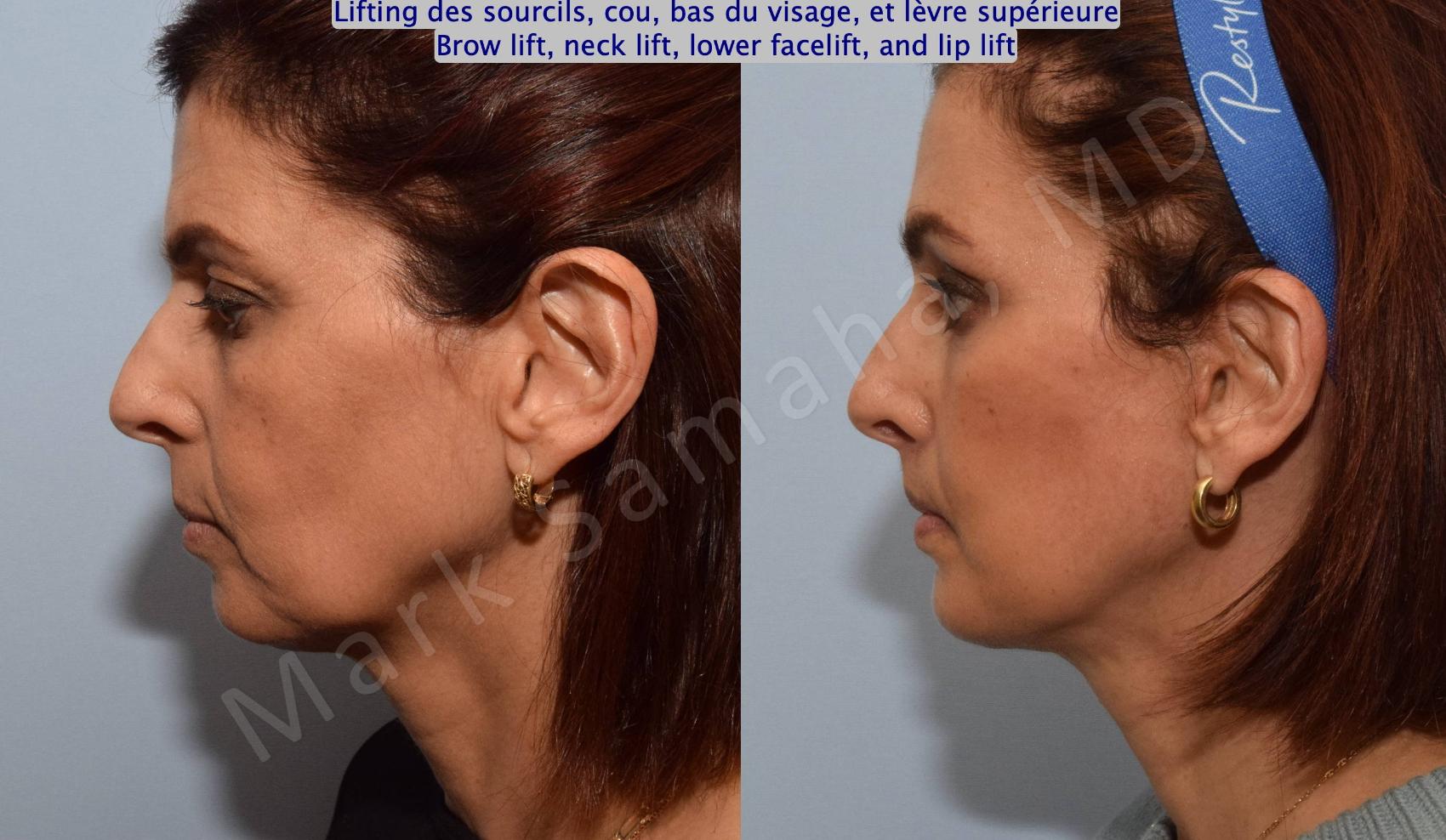 Before & After Lifting du Sourcil / Brow lift Case 195 Left Side View in Montreal, QC