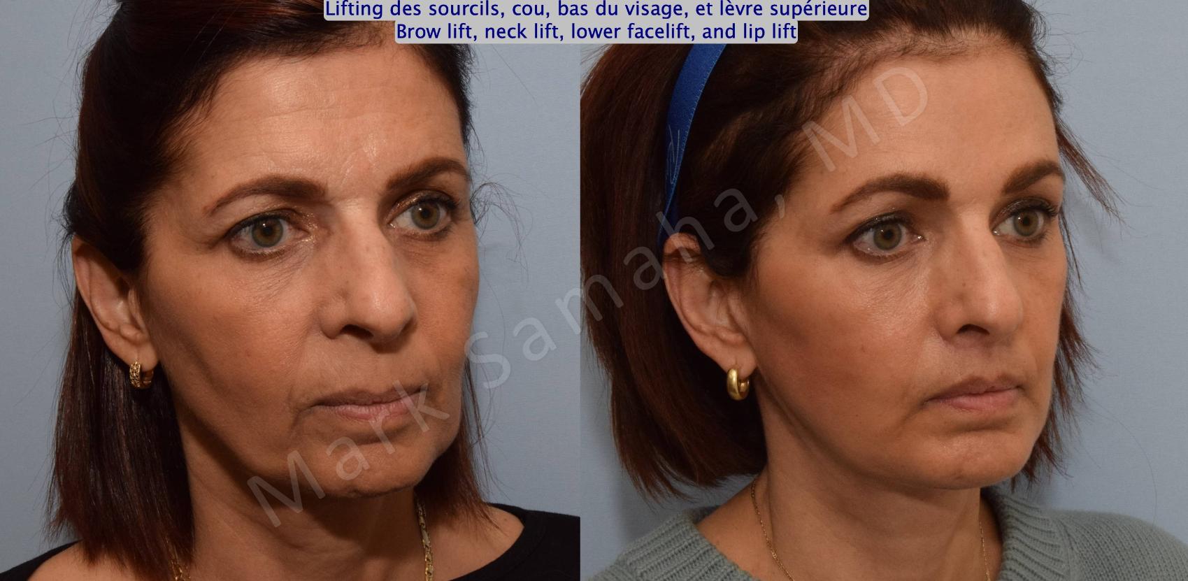Before & After Lifting du Sourcil / Brow lift Case 195 Right Oblique View in Montreal, QC