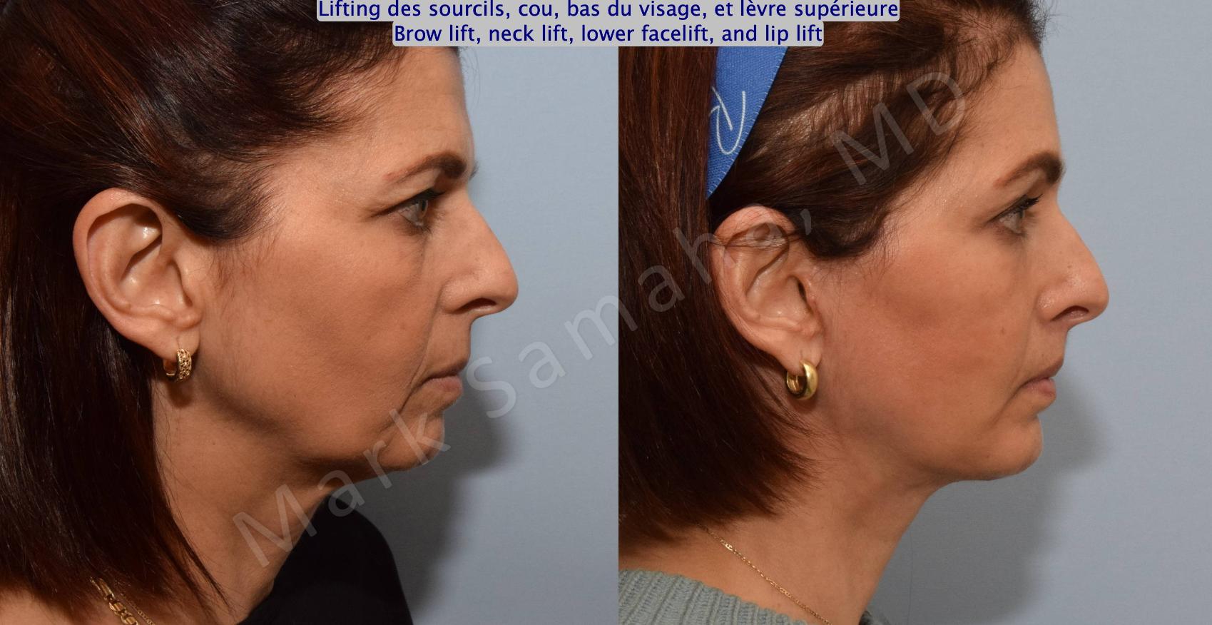 Before & After Lifting du Sourcil / Brow lift Case 195 Right Side View in Montreal, QC