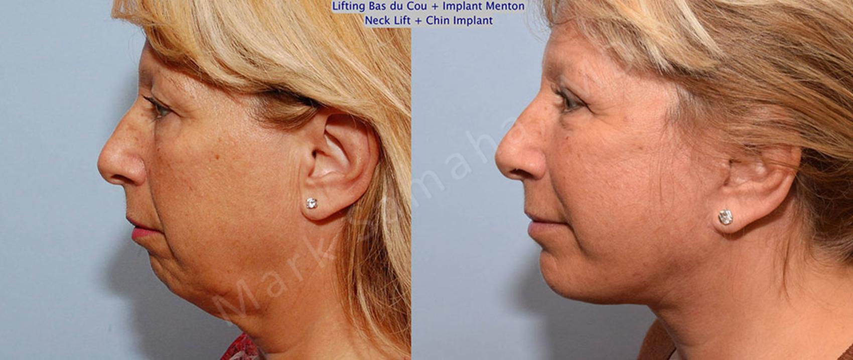 Before & After Augmentation du menton / Chin Augmentation Case 28 View #1 View in Montreal, QC