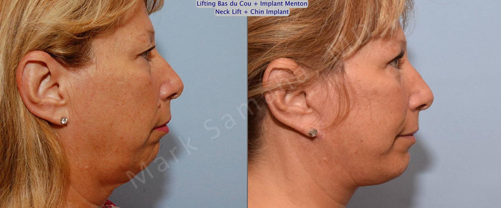 Before & After Augmentation du menton / Chin Augmentation Case 28 View #2 View in Montreal, QC