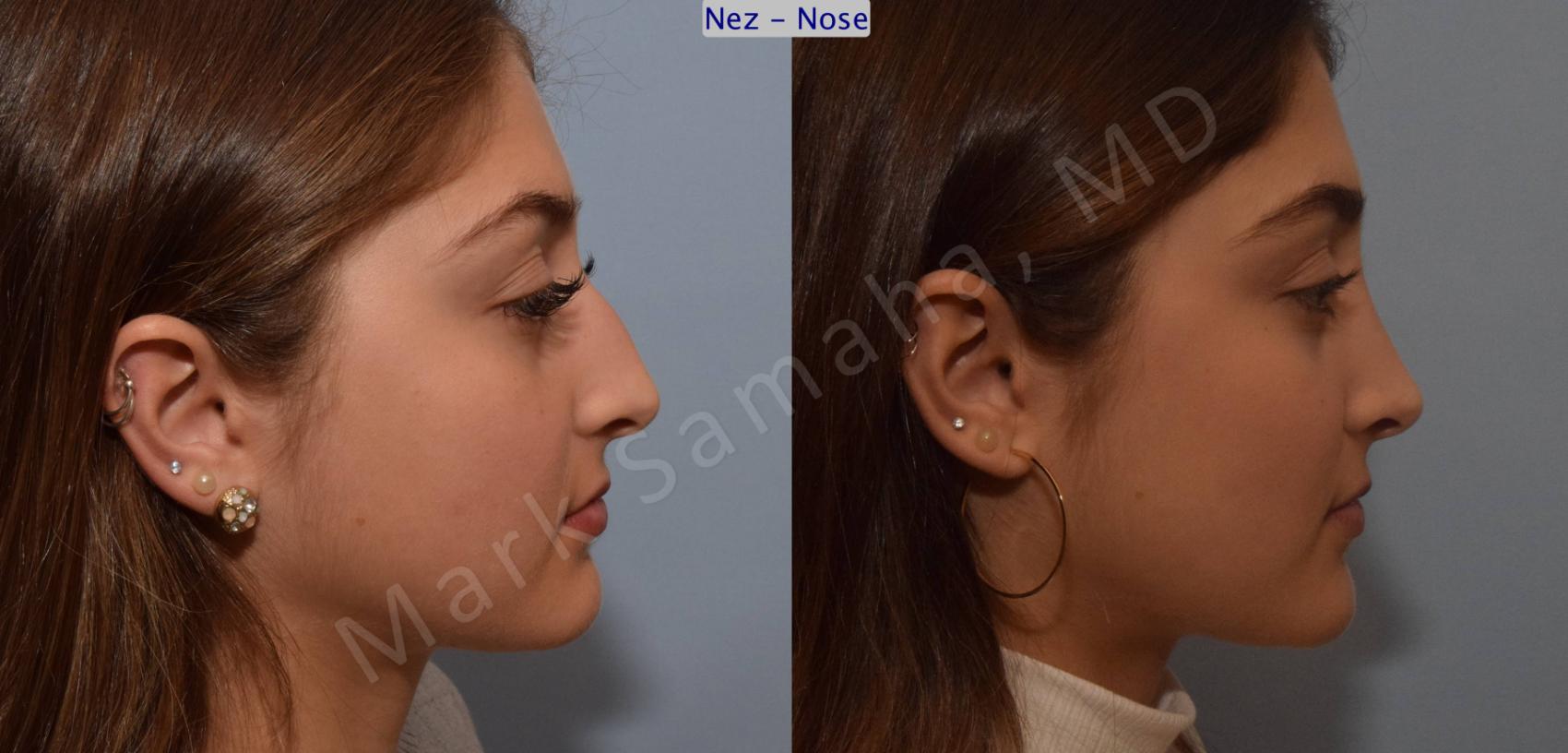 Before & After Rhinoplastie / Rhinoplasty Case 106 View #4 View in Montreal, QC