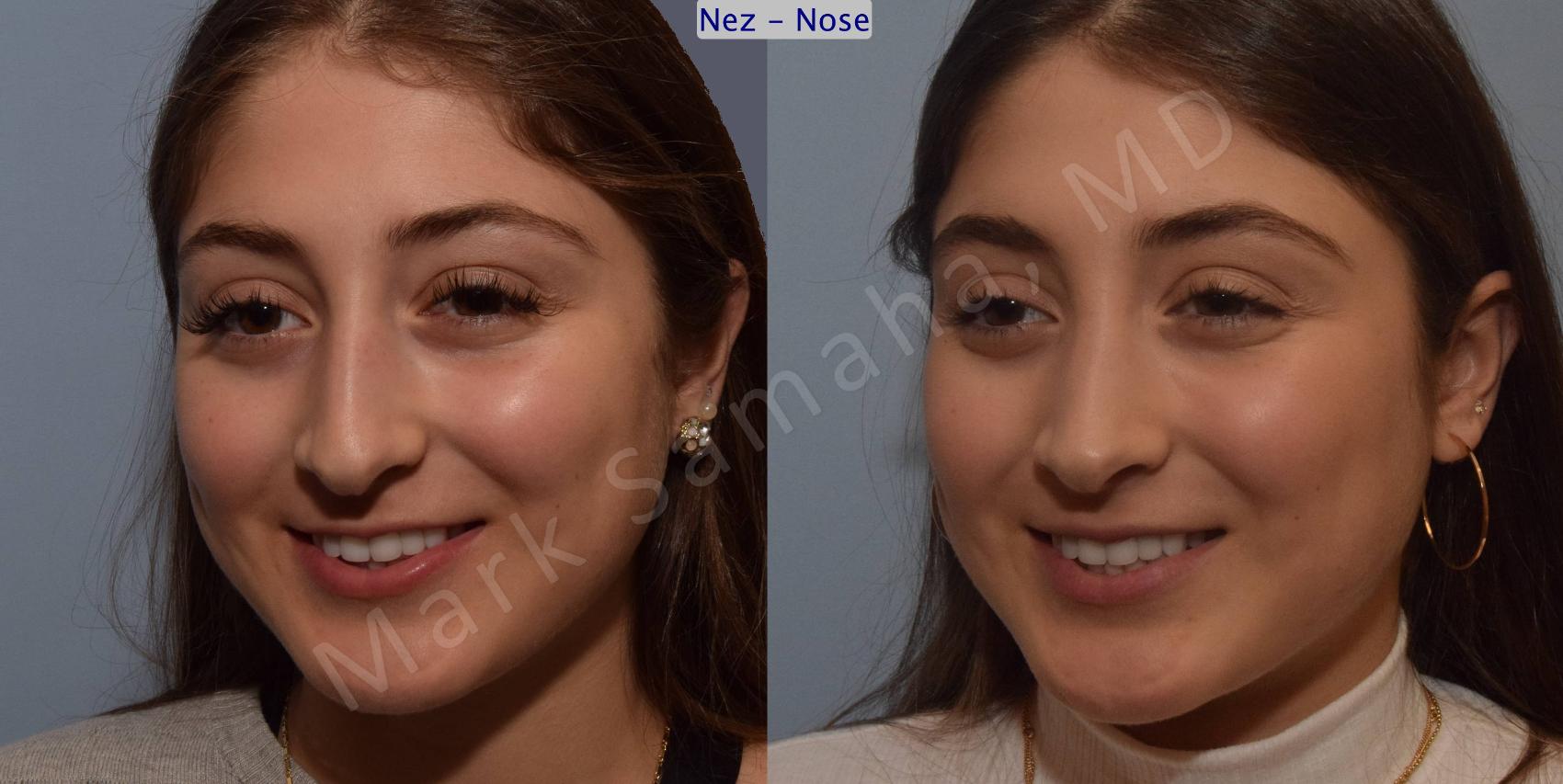 Before & After Rhinoplastie / Rhinoplasty Case 106 View #7 View in Montreal, QC