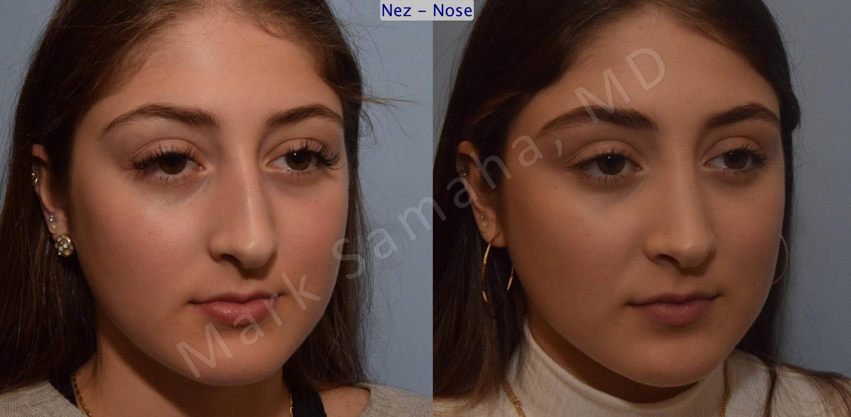 Before & After Rhinoplastie / Rhinoplasty Case 106 View #8 View in Montreal, QC