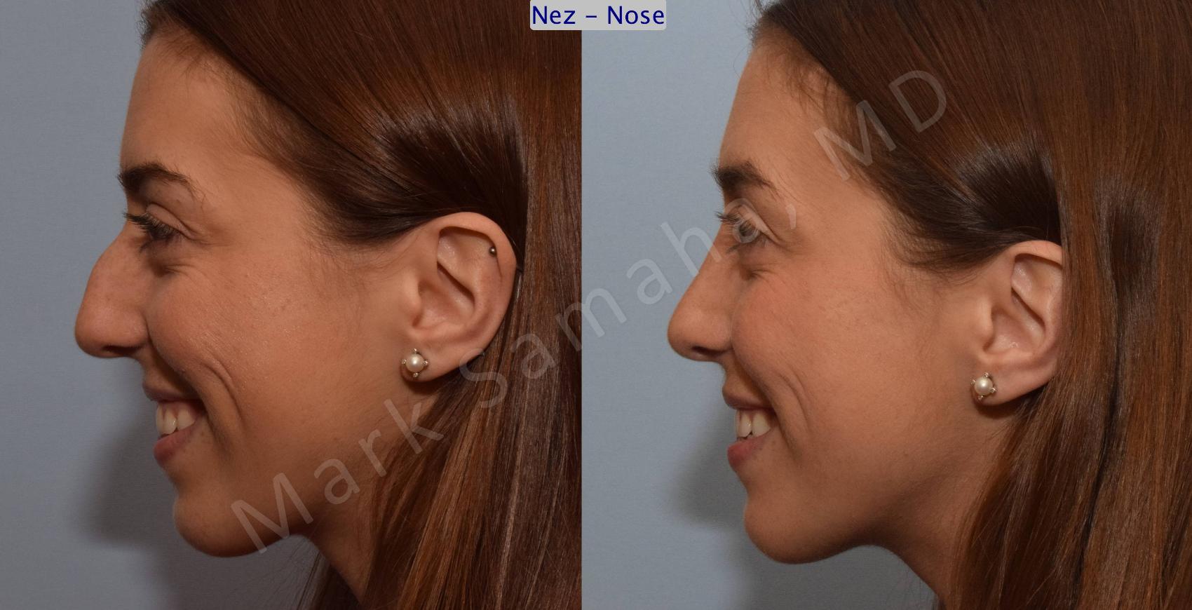 Before & After Rhinoplastie / Rhinoplasty Case 107 View #3 View in Montreal, QC