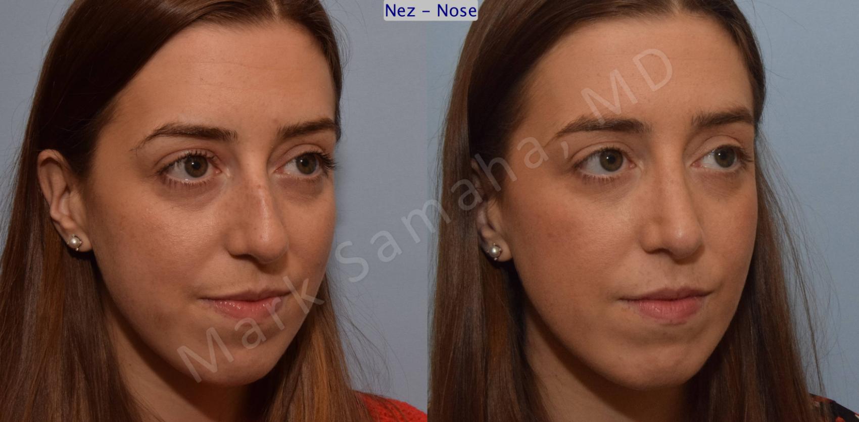 Before & After Rhinoplastie / Rhinoplasty Case 107 View #8 View in Montreal, QC