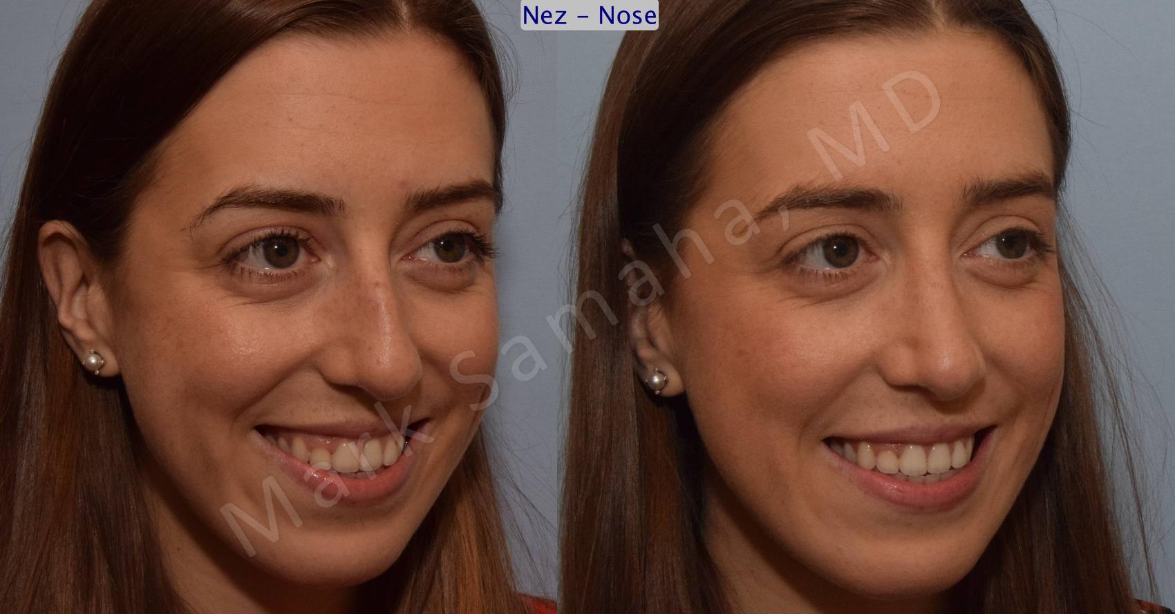 Before & After Rhinoplastie / Rhinoplasty Case 107 View #9 View in Montreal, QC