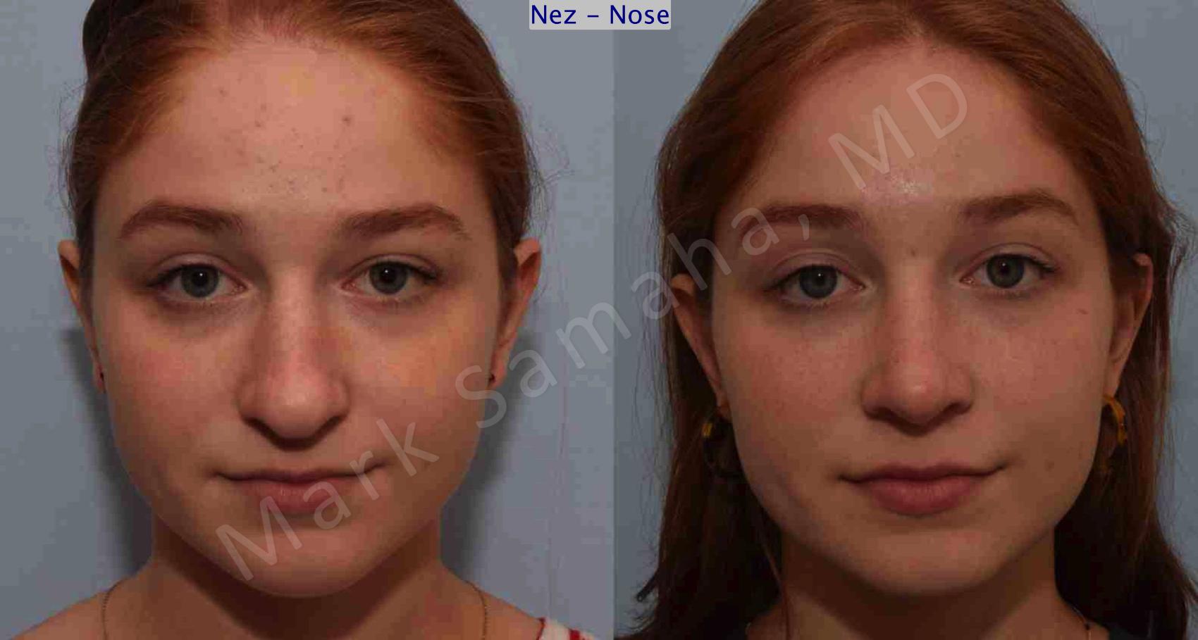 Before & After Rhinoplastie / Rhinoplasty Case 108 View #1 View in Montreal, QC