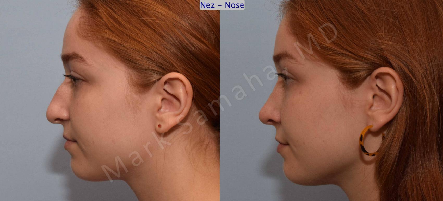 Before & After Rhinoplastie / Rhinoplasty Case 108 View #3 View in Montreal, QC