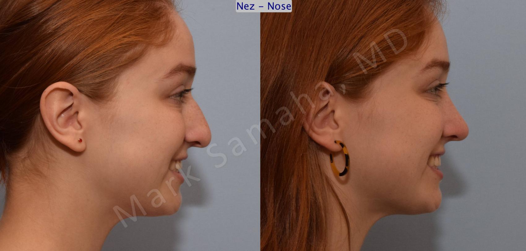 Before & After Rhinoplastie / Rhinoplasty Case 108 View #6 View in Montreal, QC