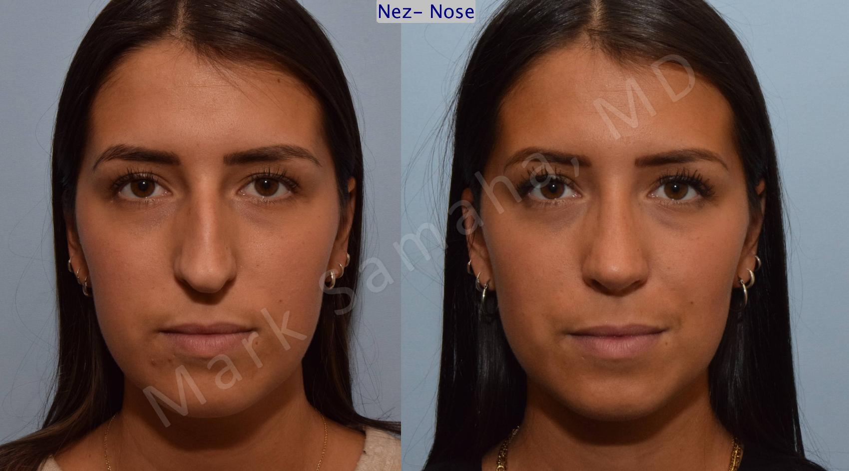 Before & After Rhinoplastie / Rhinoplasty Case 114 View #1 View in Montreal, QC