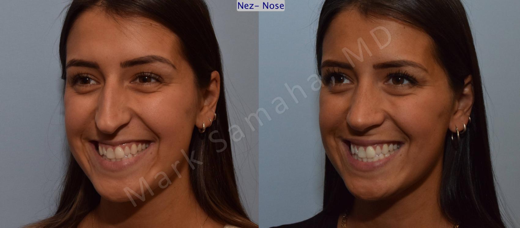 Before & After Rhinoplastie / Rhinoplasty Case 114 View #2 View in Montreal, QC