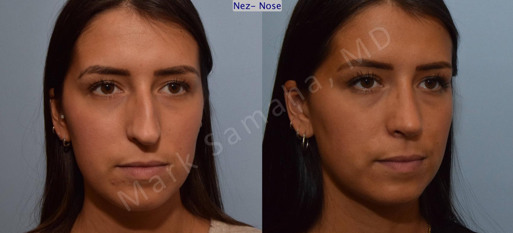 Before & After Rhinoplastie / Rhinoplasty Case 114 View #5 View in Montreal, QC
