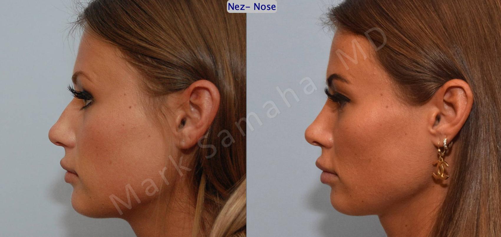 Before & After Rhinoplastie / Rhinoplasty Case 123 View #2 View in Montreal, QC