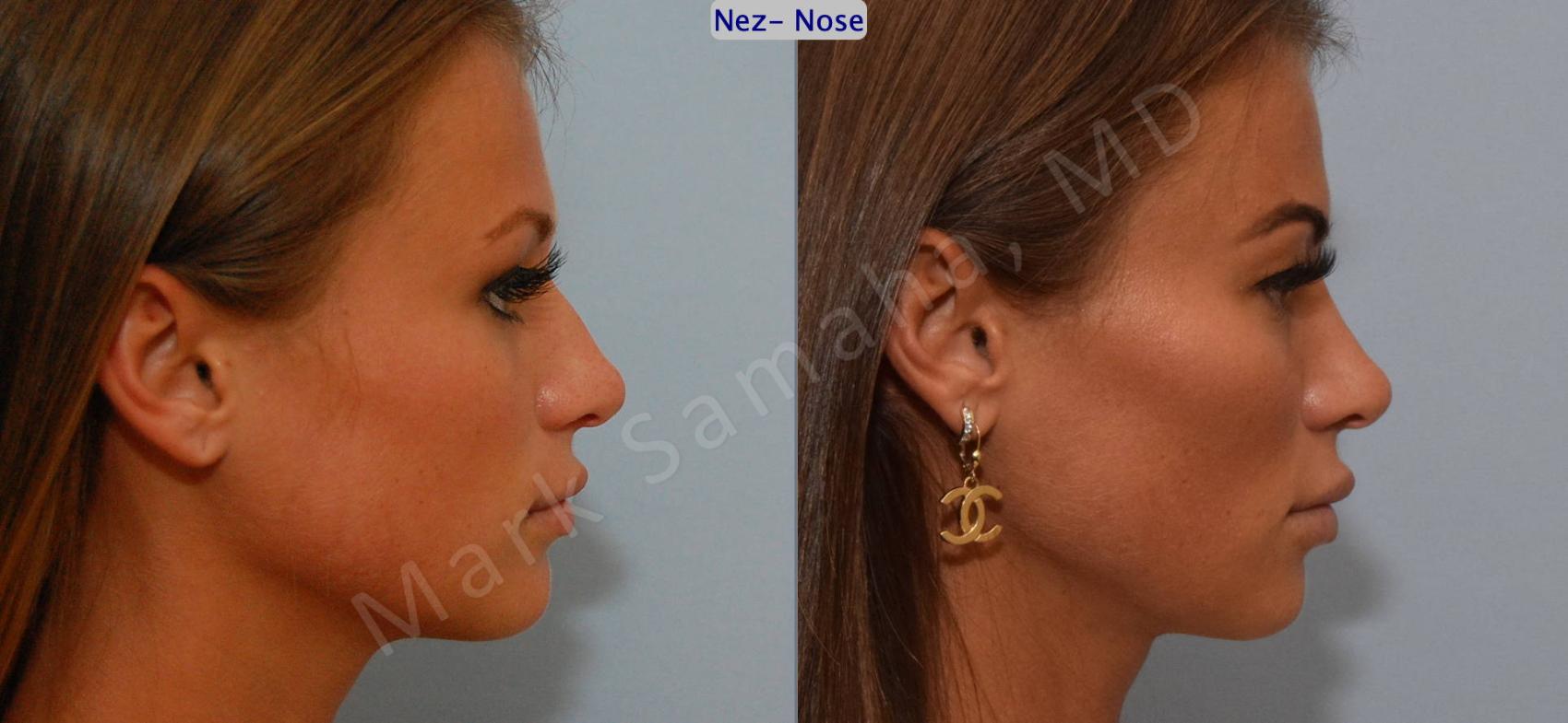 Before & After Rhinoplastie / Rhinoplasty Case 123 View #3 View in Montreal, QC