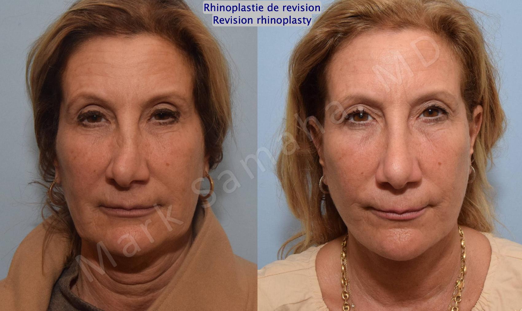 Before & After Rhinoplastie / Rhinoplasty Case 181 Front View in Montreal, QC