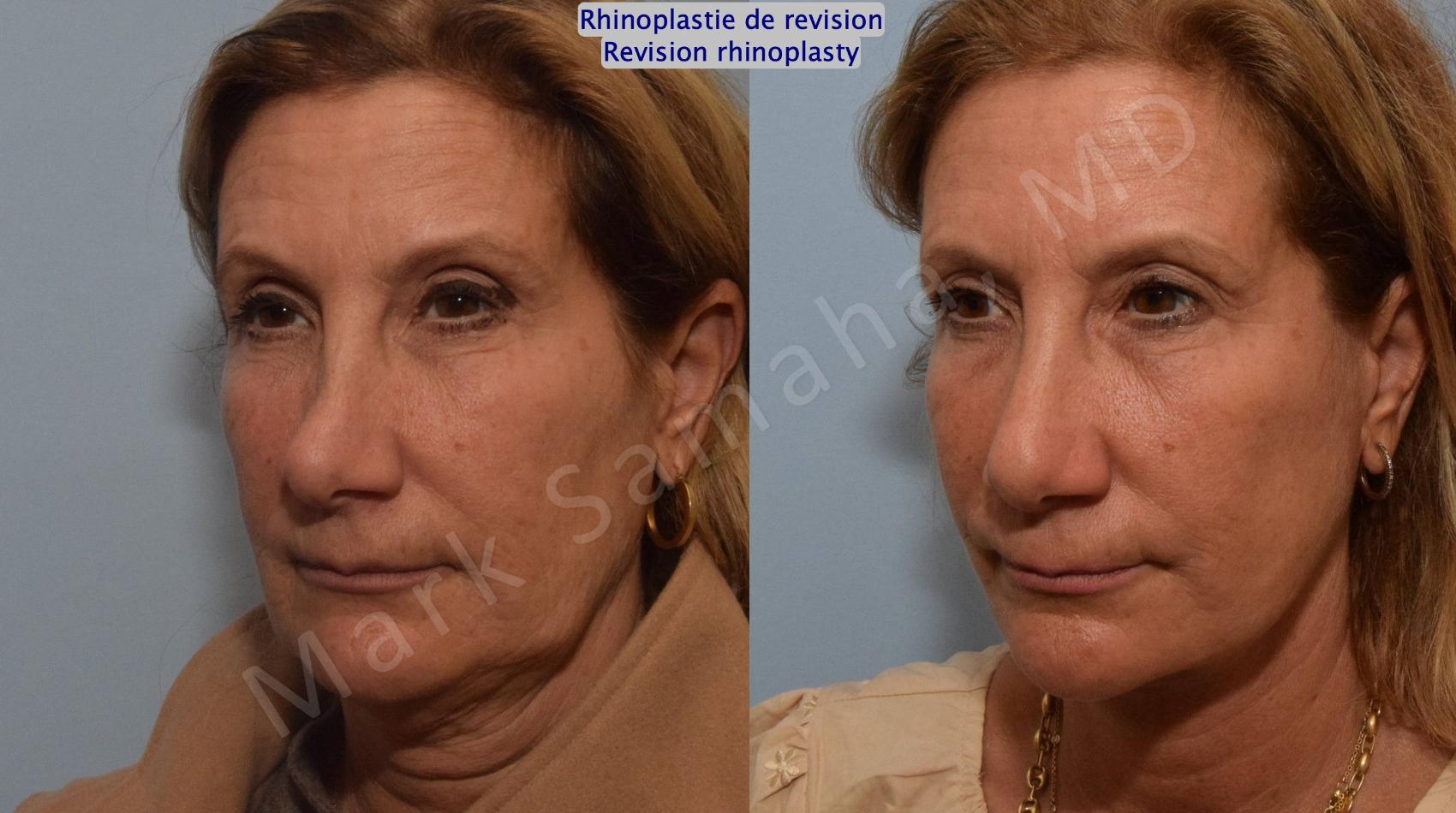 Before & After Rhinoplastie / Rhinoplasty Case 181 Left Oblique View in Montreal, QC