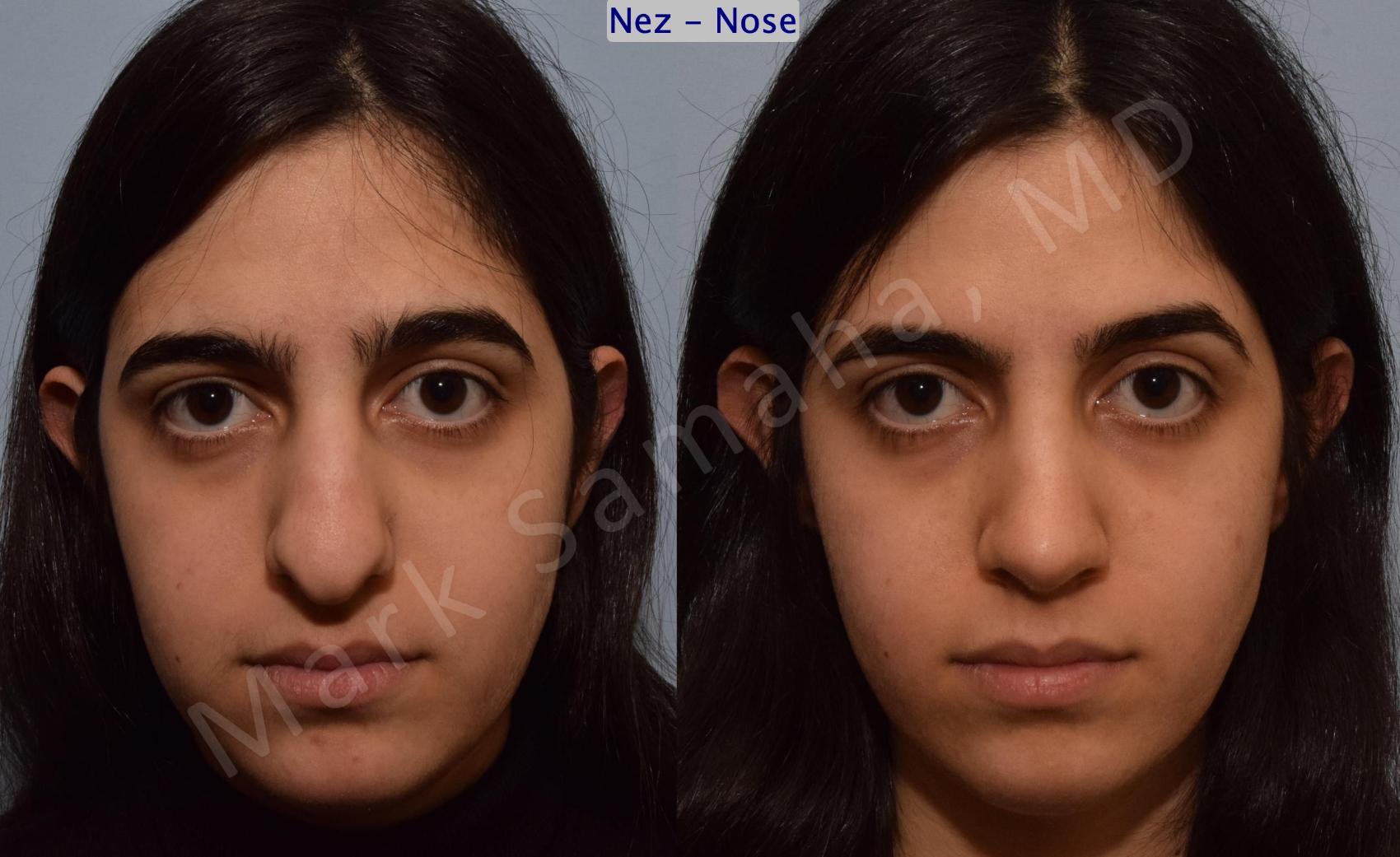 Before & After Rhinoplastie / Rhinoplasty Case 183 Left Oblique View in Montreal, QC