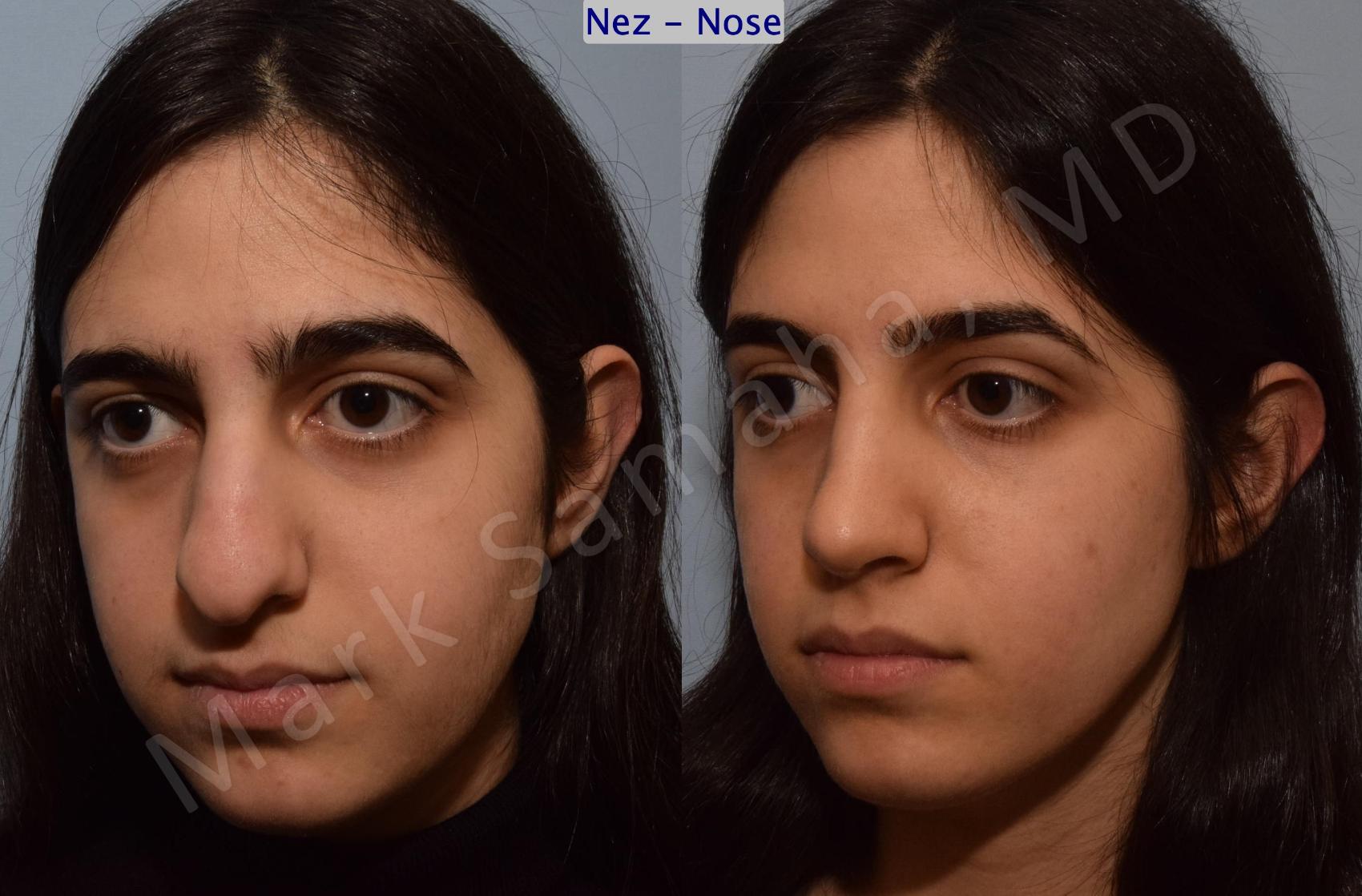 Before & After Rhinoplastie / Rhinoplasty Case 183 Left Oblique View in Montreal, QC