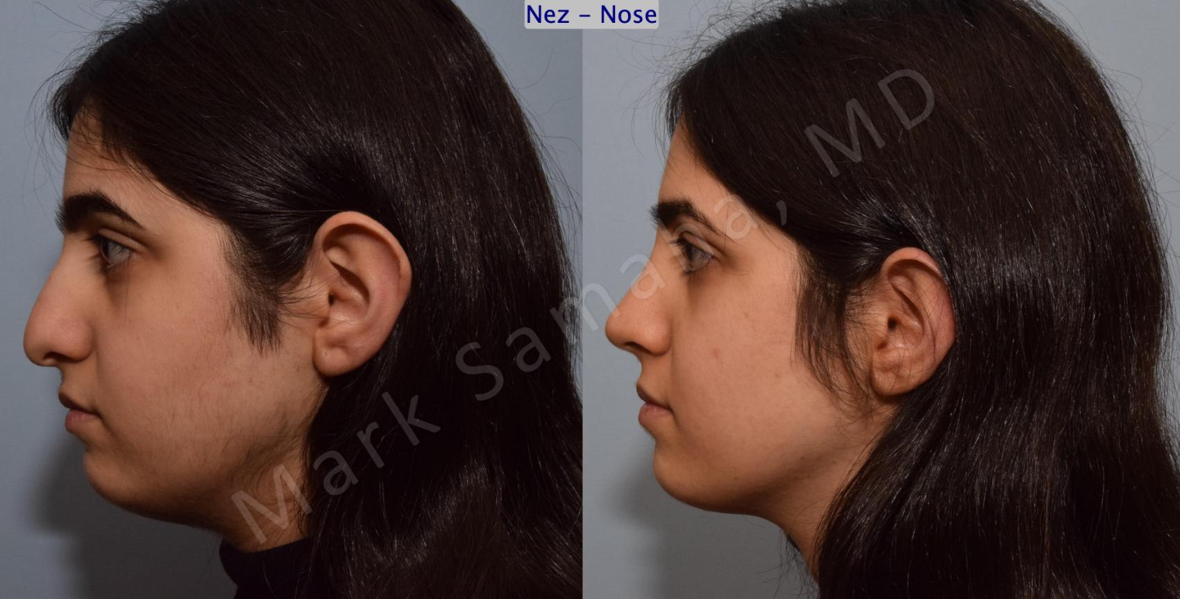 Before & After Rhinoplastie / Rhinoplasty Case 183 Left Side View in Montreal, QC