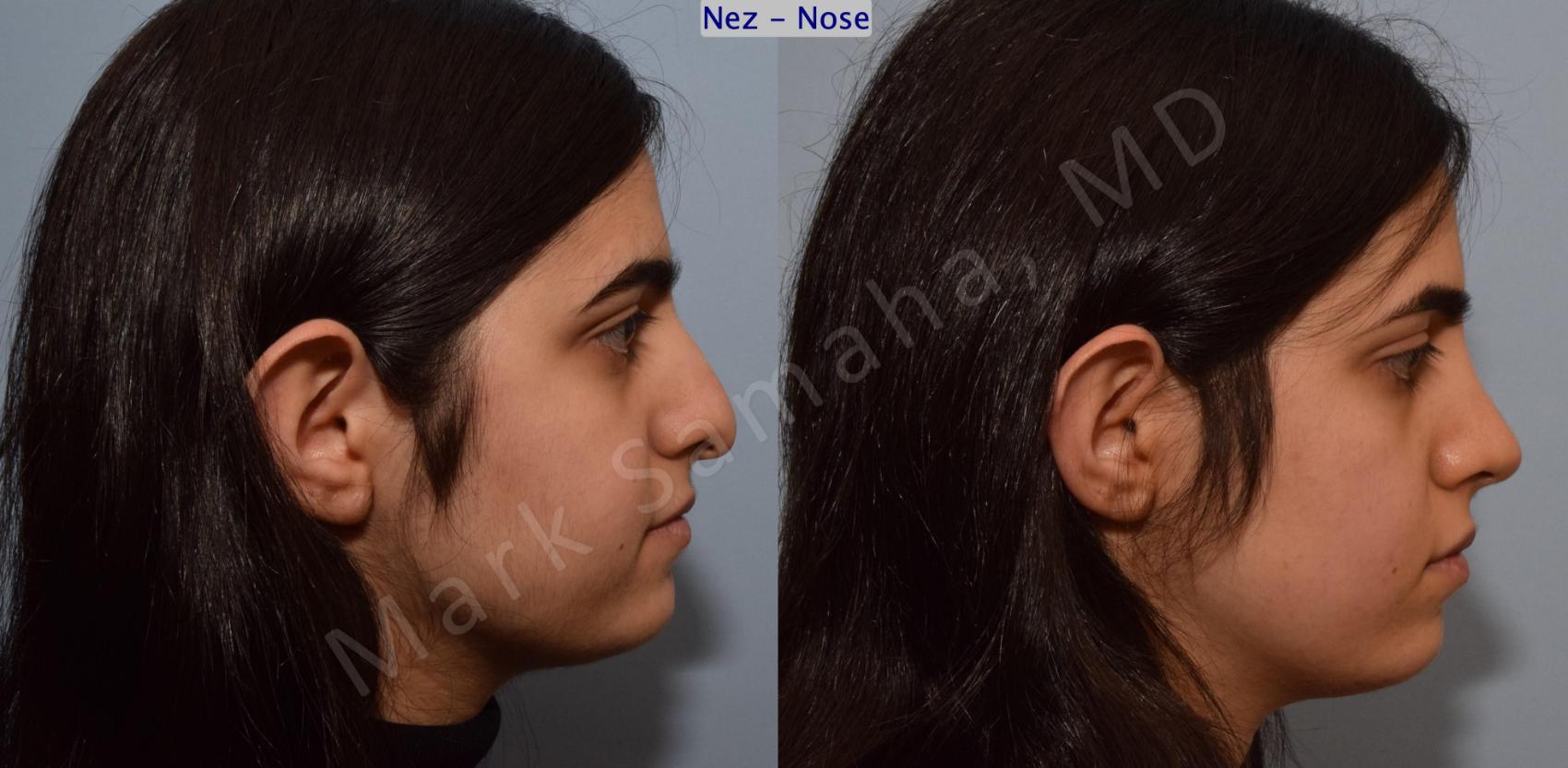 Before & After Rhinoplastie / Rhinoplasty Case 183 Right Side View in Montreal, QC