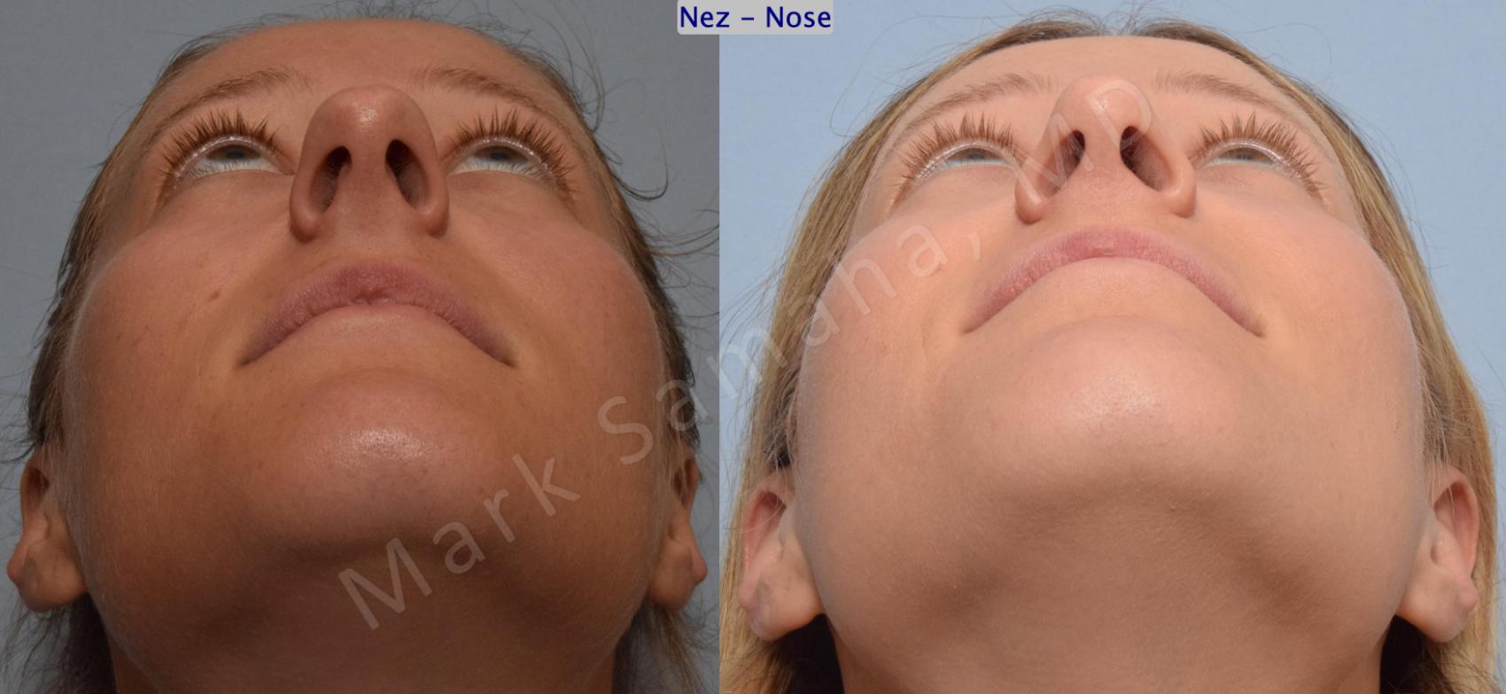 Before & After Rhinoplastie / Rhinoplasty Case 186 Basal View in Montreal, QC