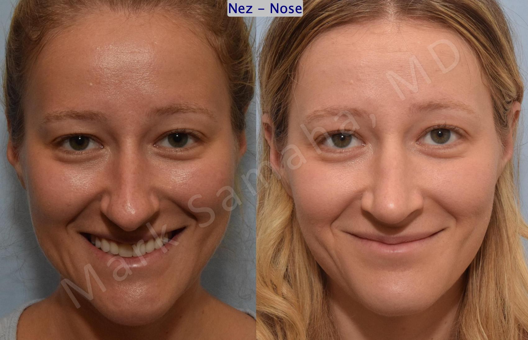 Before & After Rhinoplastie / Rhinoplasty Case 186 Front Smile View in Montreal, QC