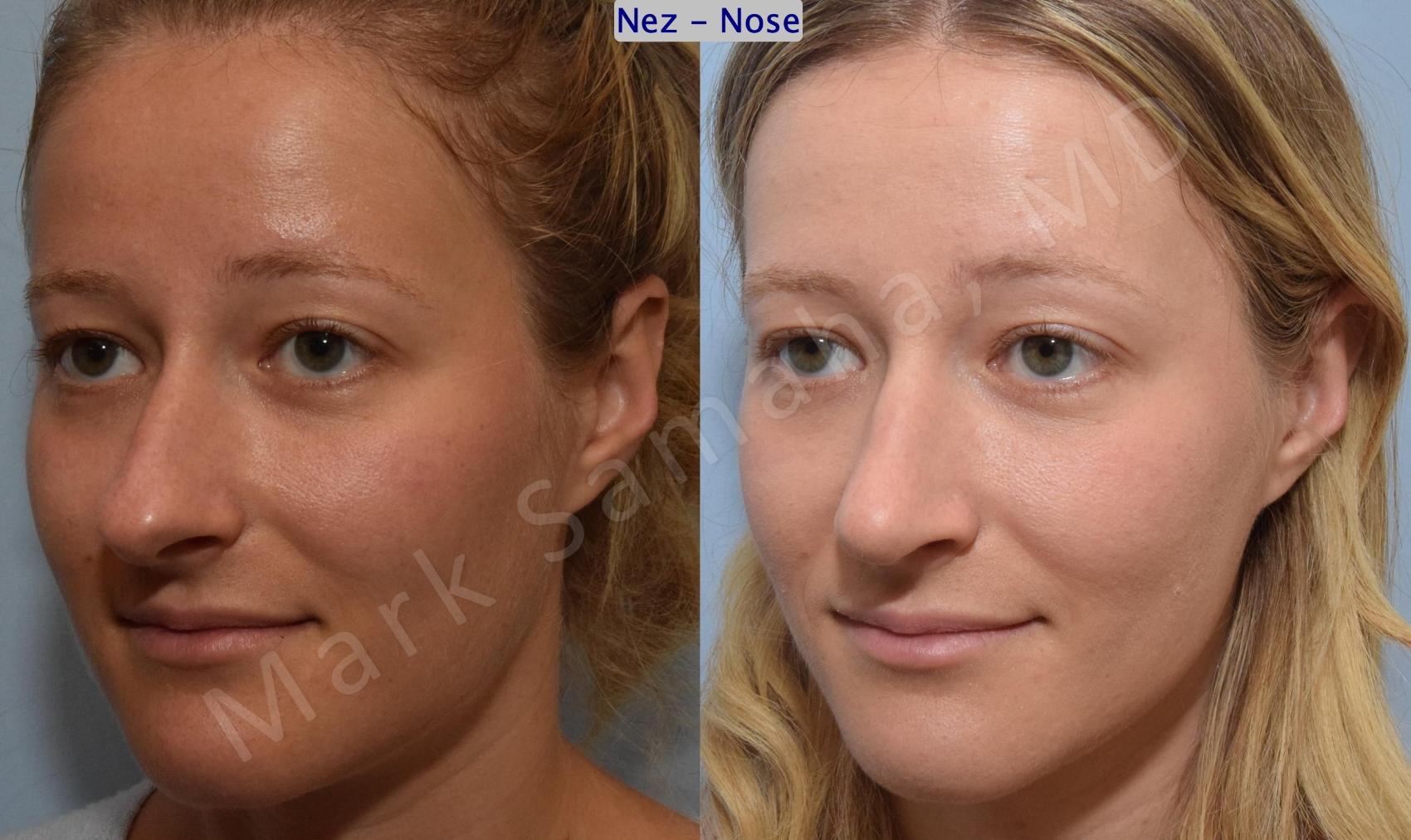 Before & After Rhinoplastie / Rhinoplasty Case 186 Left Oblique View in Montreal, QC