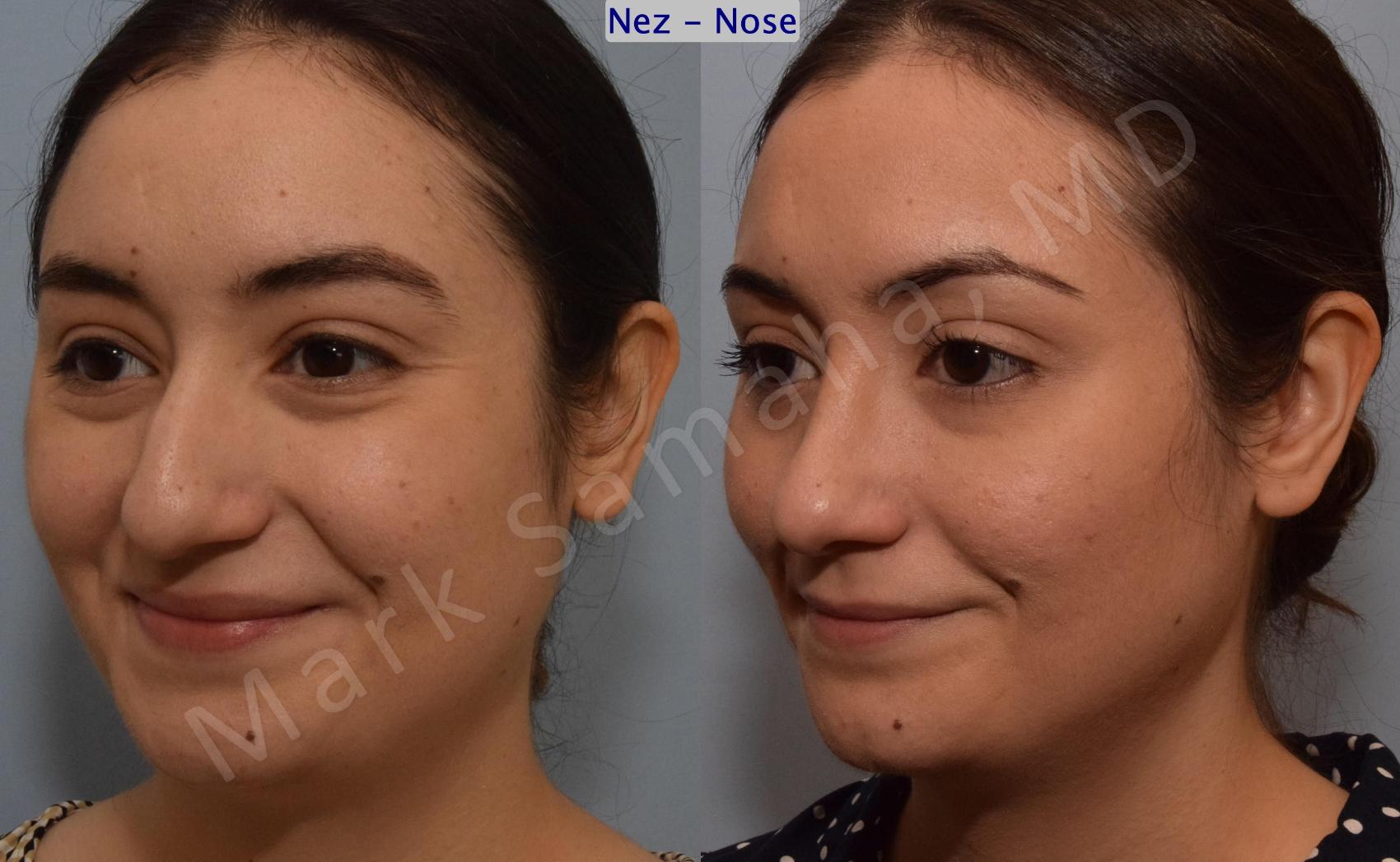 Before & After Rhinoplastie / Rhinoplasty Case 187 Left Oblique Smile View in Montreal, QC