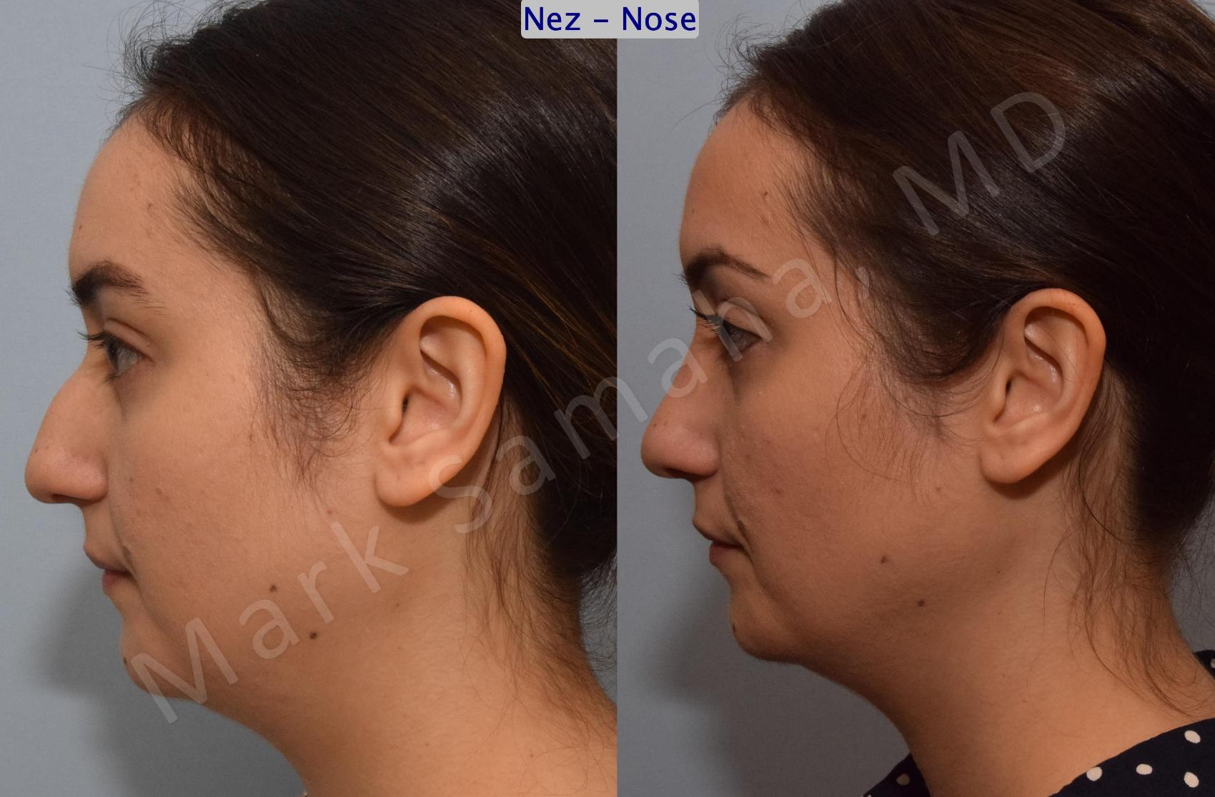 Before & After Rhinoplastie / Rhinoplasty Case 187 Left Side View in Montreal, QC