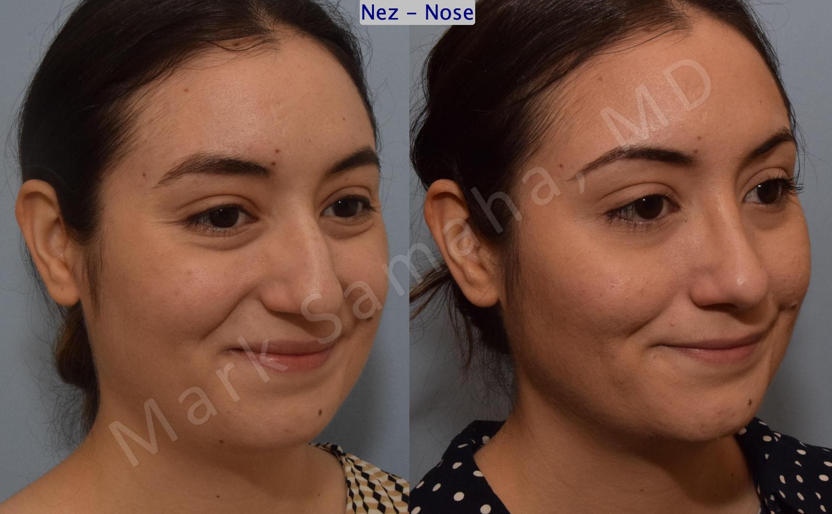 Before & After Rhinoplastie / Rhinoplasty Case 187 Right Oblique Smile View in Montreal, QC
