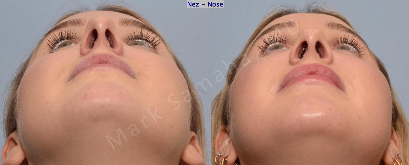 Before & After Rhinoplastie / Rhinoplasty Case 188 Basal View in Montreal, QC