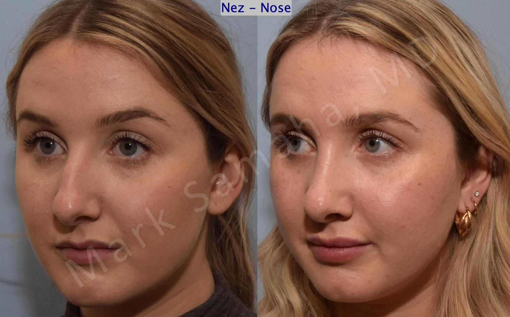 Before & After Rhinoplastie / Rhinoplasty Case 188 Left Oblique View in Montreal, QC