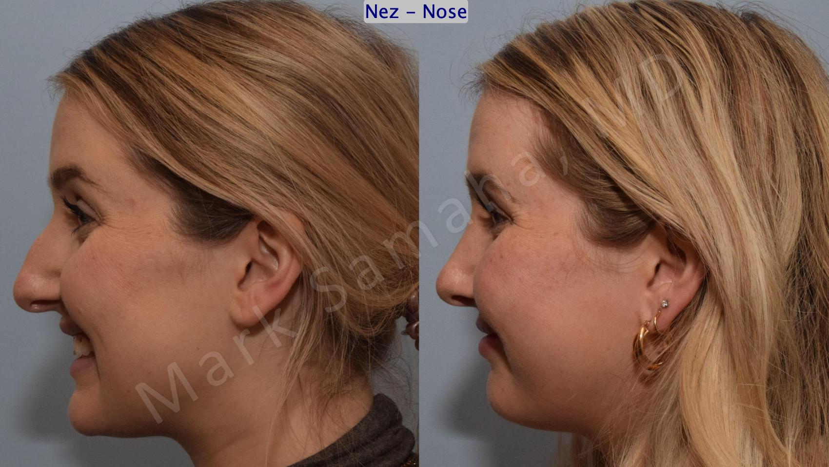 Before & After Rhinoplastie / Rhinoplasty Case 188 Left Side Smile View in Montreal, QC